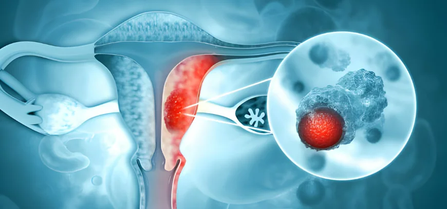 Gynecological Cancers treatment in kokapet